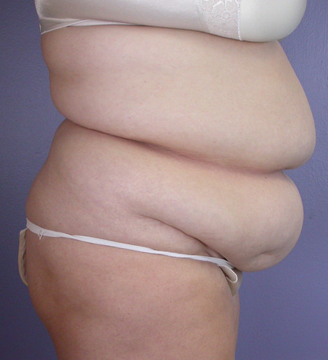 Liposuction before and after photo