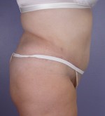 Liposuction Before and after photo