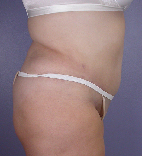 Liposuction before and after photo