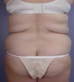 Liposuction Before and after photo