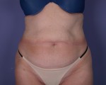 Liposuction