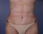 Liposuction