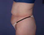 Liposuction