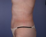 Liposuction