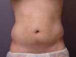 Liposuction