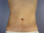 Liposuction