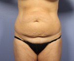 Liposuction