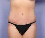 Liposuction