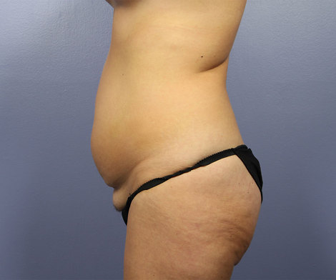 Liposuction before and after photo