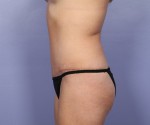 Liposuction Before and after photo