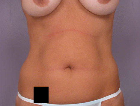 Liposuction before and after photo