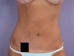 Liposuction Before and after photo