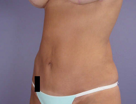 Liposuction before and after photo