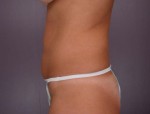 Liposuction Before and after photo