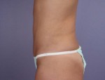 Liposuction Before and after photo