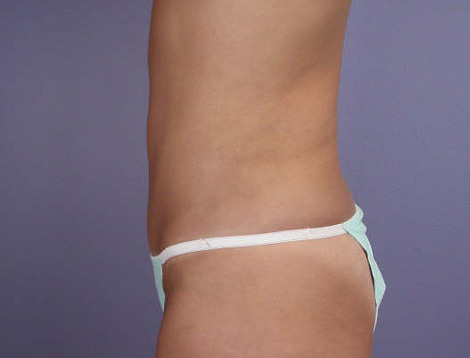 Liposuction before and after photo