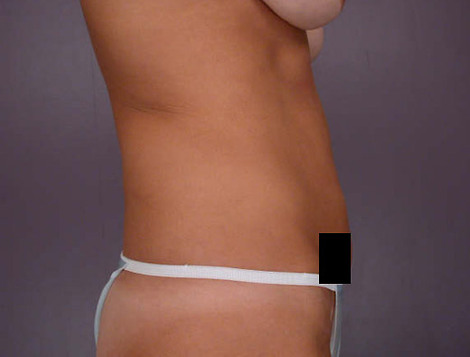 Liposuction before and after photo