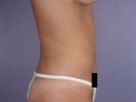 Liposuction Before and after photo