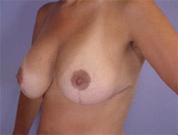 Liposuction before and after photo