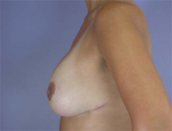 Liposuction before and after photo