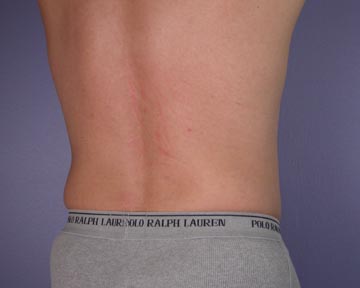 Liposuction before and after photo