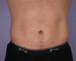 Liposuction