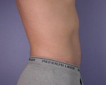 Liposuction