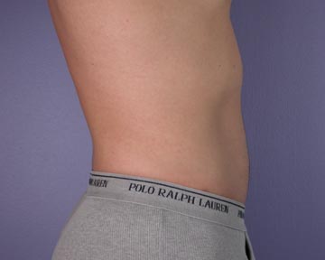 Liposuction before and after photo