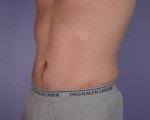 Liposuction Before and after photo