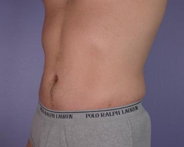 Liposuction before and after photo