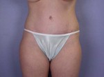 Liposuction Before and after photo