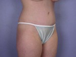 Liposuction Before and after photo