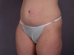 Liposuction Before and after photo