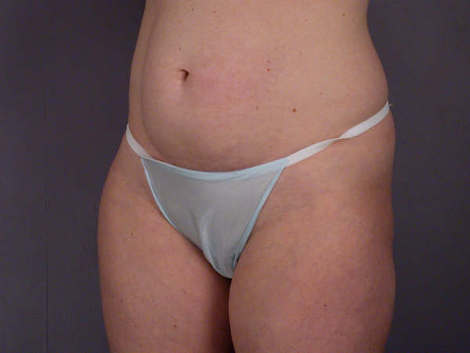 Liposuction before and after photo