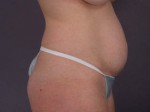 Liposuction Before and after photo