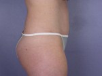 Liposuction Before and after photo