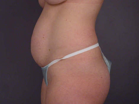 Liposuction before and after photo