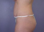 Liposuction Before and after photo