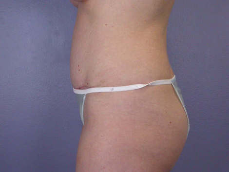 Liposuction before and after photo