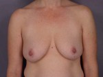 Liposuction Before and after photo