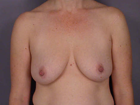 Liposuction before and after photo