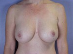 Liposuction Before and after photo