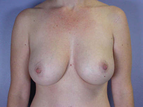 Liposuction before and after photo