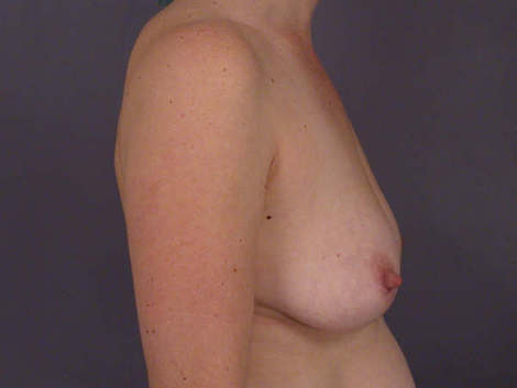 Liposuction before and after photo