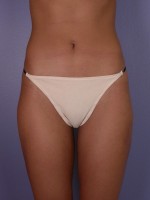 Liposuction