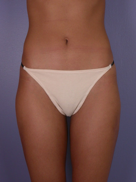 Liposuction before and after photo