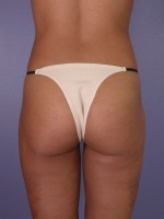 Liposuction