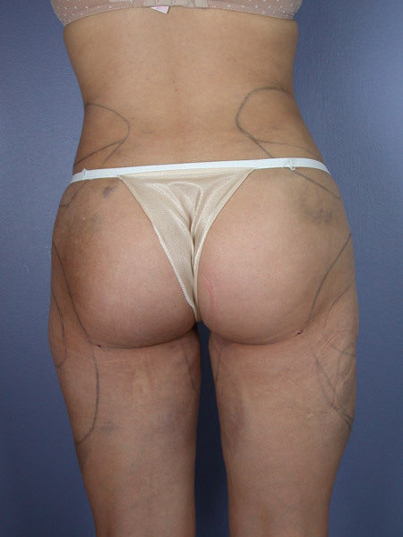 Liposuction before and after photo
