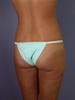 Liposuction Before and after photo