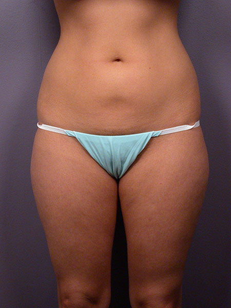 Liposuction before and after photo